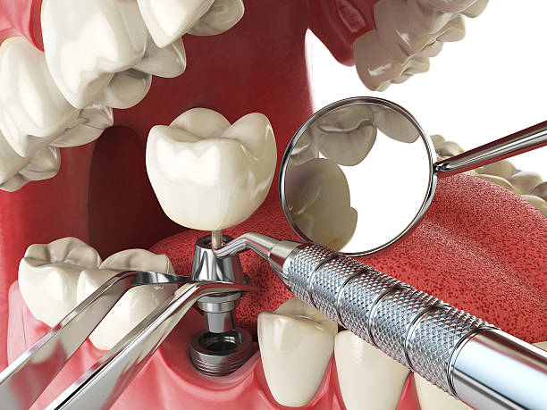 Best Emergency Treatment for Dental Infections or Abscesses in Norco, LA